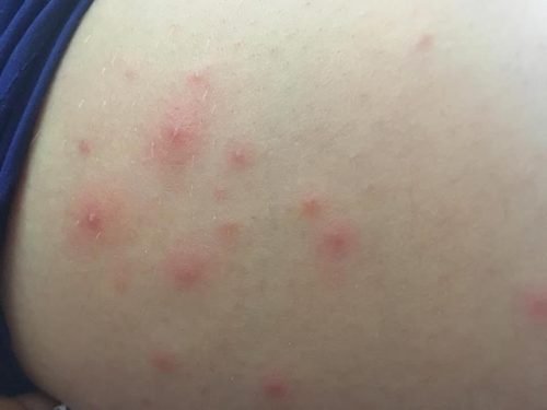 Bolinhas de foliculite no bumbum