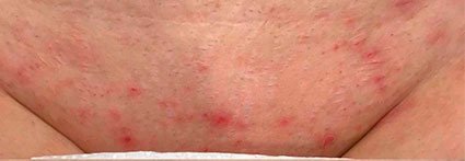 Virilha irritada após a depilação