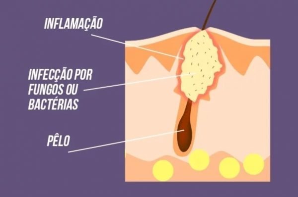 Ilustração de um folículo piloso inflamado