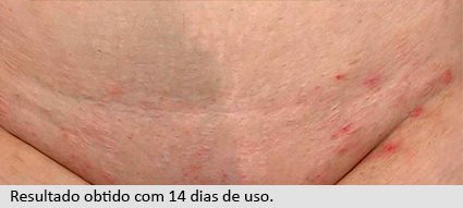 Resultado obtido com 14 dias de uso