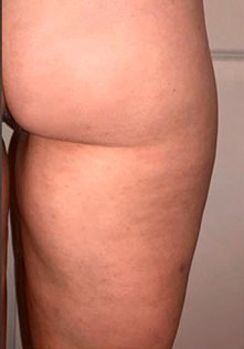 Bumbum sem bolinhas após o uso do Folipro